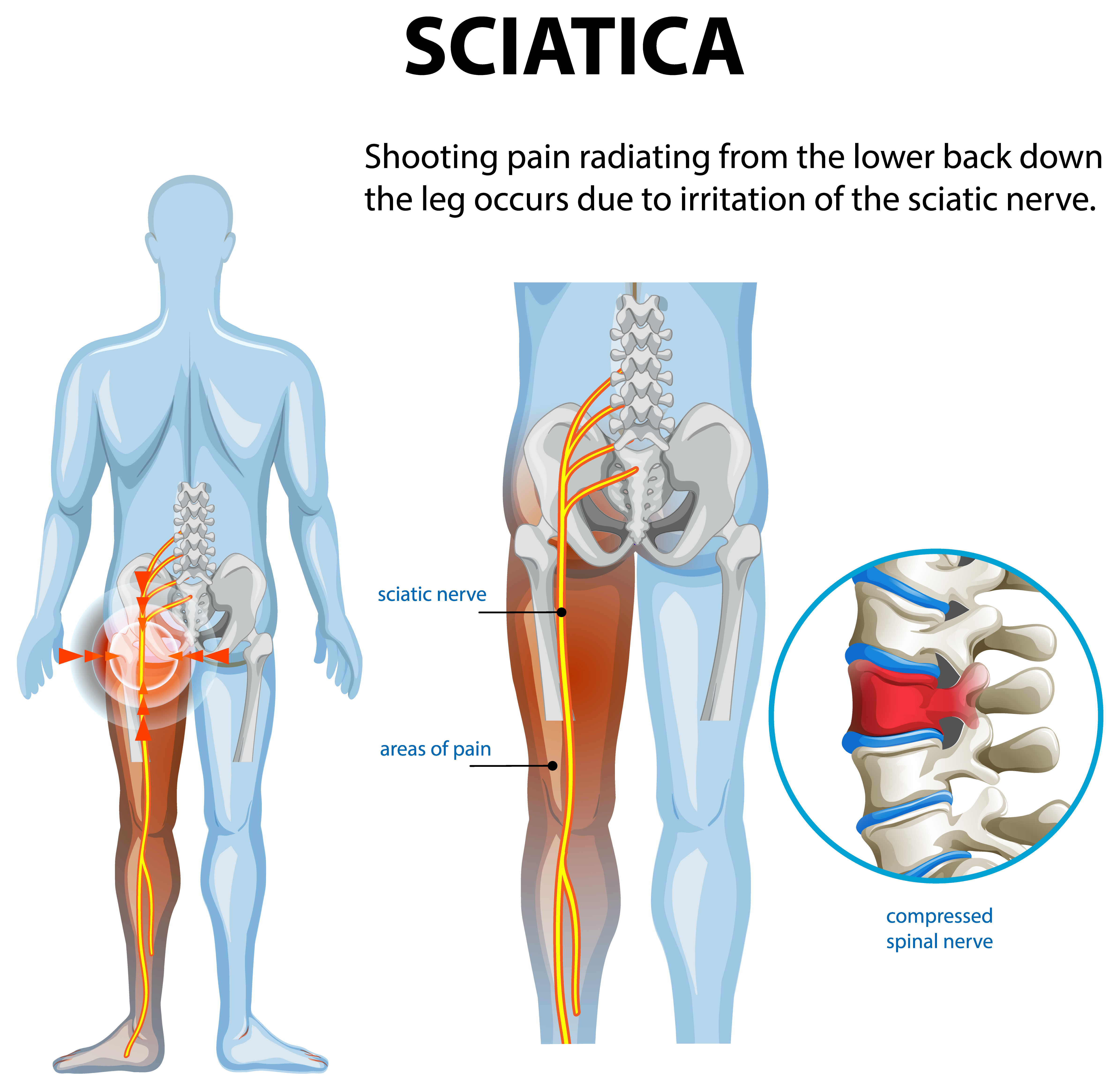 Sciatica in Athletes: How to Manage Pain and Stay Active 1 Sciatica in Athletes: How to Manage Pain and Stay Active