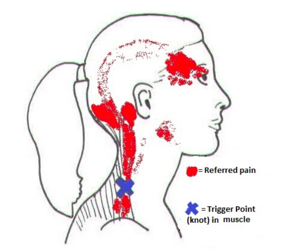 Migraines and Neck Pain: Finding Relief through Chiropractic Care 1 Migraines and Neck Pain: Finding Relief through Chiropractic Care