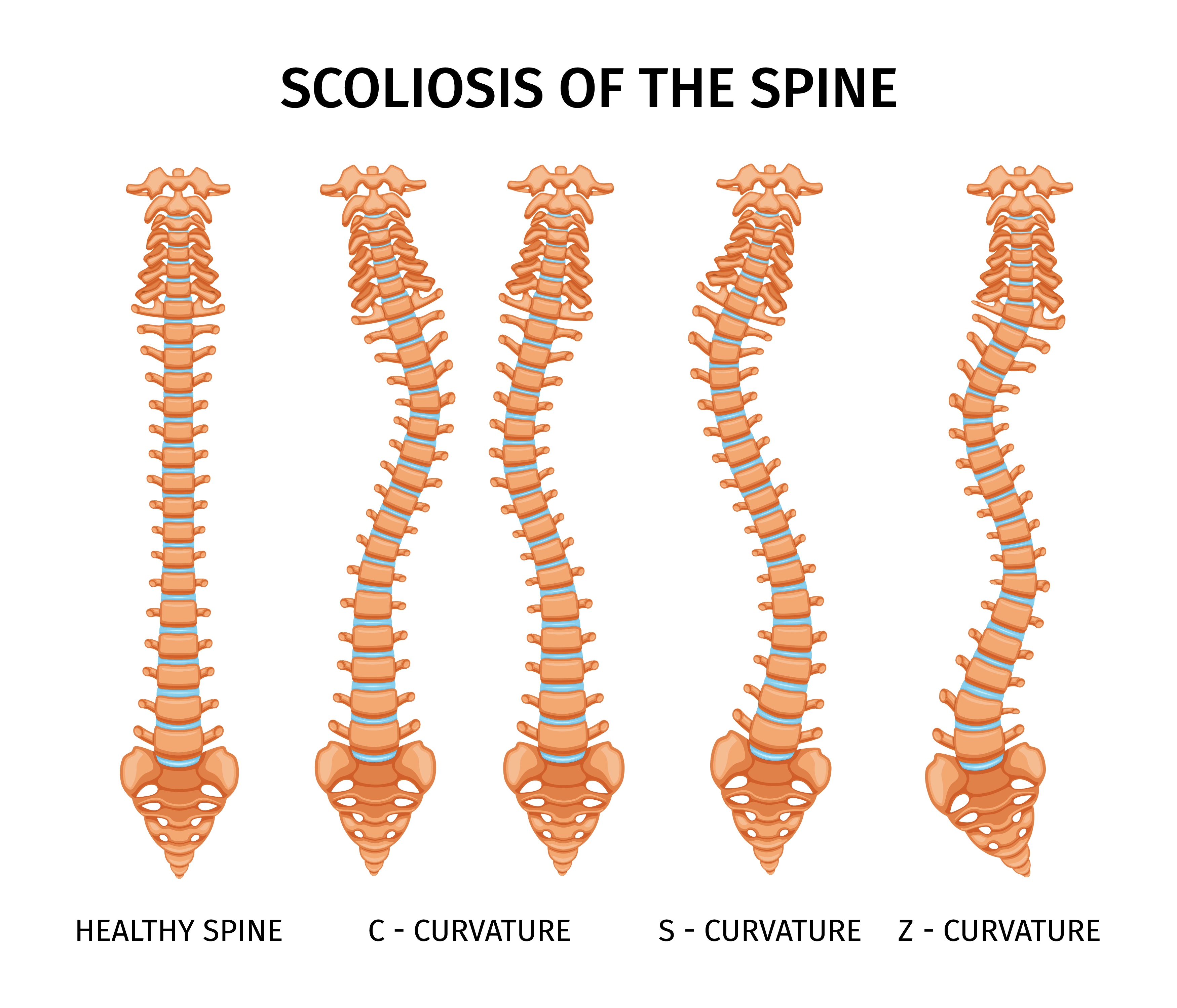 Scoliosis and Posture: Tips for Maintaining a Healthy Spine 1 Scoliosis and Posture: Tips for Maintaining a Healthy Spine