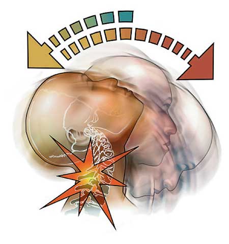 Why You Should See A Chiropractor for Whiplash 1 Why You Should See A Chiropractor for Whiplash