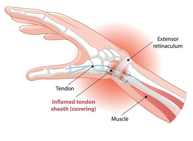 The Different Types of Carpal Tunnel & Their Common Causes 1 The Different Types of Carpal Tunnel & Their Common Causes